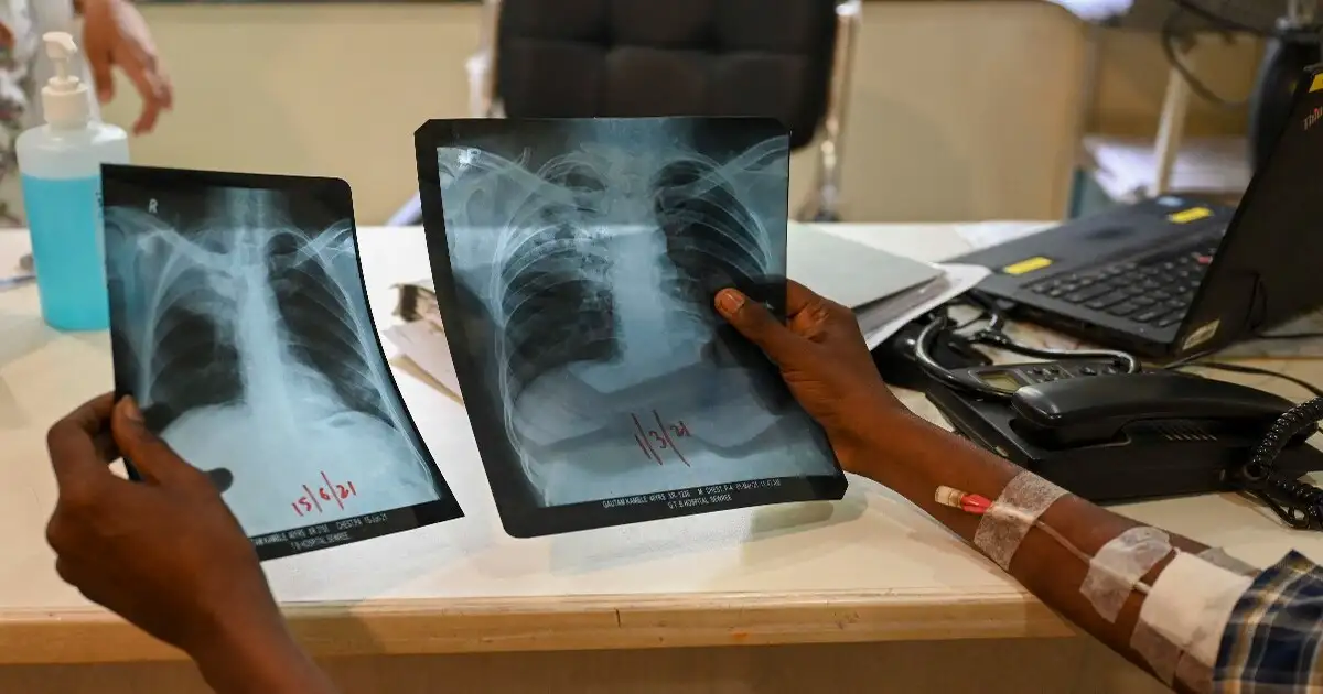 ભારતમાં TB અને મલેરિયા સામે મોટી જીત, છેલ્લા 10 વર્ષમાં કેસોમાં ભારે ઘટાડો